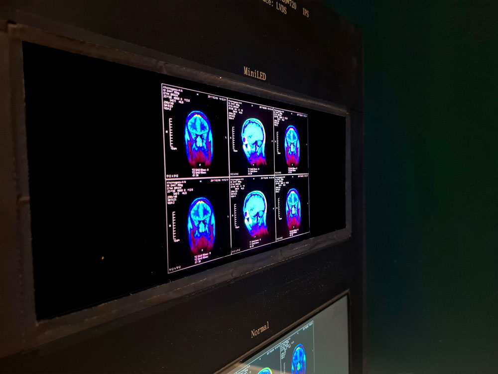 mini led display with local dimming